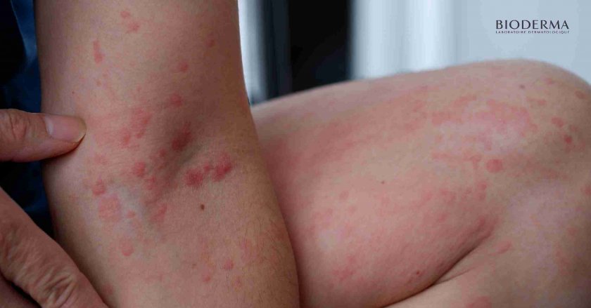 ผื่นลมพิษ (Urticaria)