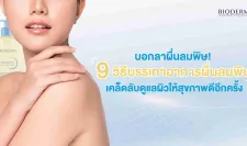 บอกลาผื่นลมพิษ! 9 วิธีบรรเทาอาการผื่นลมพิษ เคล็ดลับดูแลผิวให้สุขภาพดีอีกครั้ง