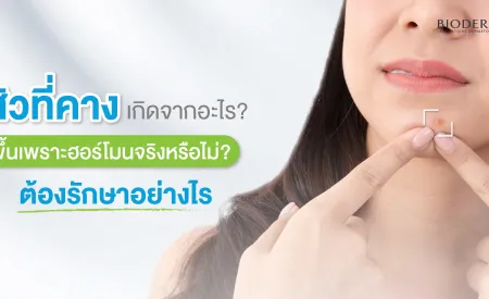 สิวที่คาง เกิดจากอะไร? ขึ้นเพราะฮอร์โมนจริงหรือไม่? ต้องรักษาอย่างไร